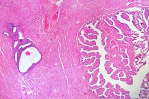 Endometriosis cells