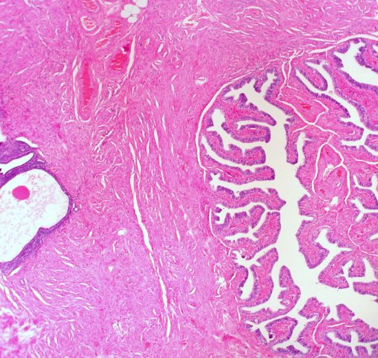 Endometriosis cells